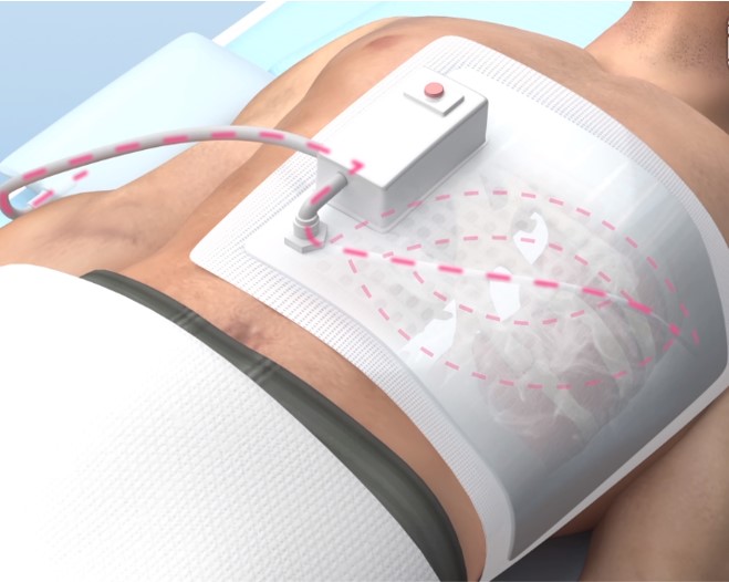 胸部負壓支撐器：胸部嚴重損傷的救治利器